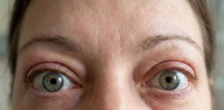 Enfermedad ocular tiroidea: síntomas y cómo evitar la odisea de llegar al diagnóstico
