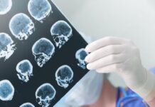 Parkinson: una enfermedad poco visibilizada que crece y afecta a más de 100 mil argentinos