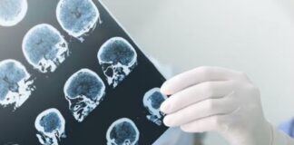 Parkinson: una enfermedad poco visibilizada que crece y afecta a más de 100 mil argentinos