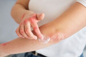 Dermatitis atópica: una encuesta revela las dificultades para sostener la atención y el tratamiento